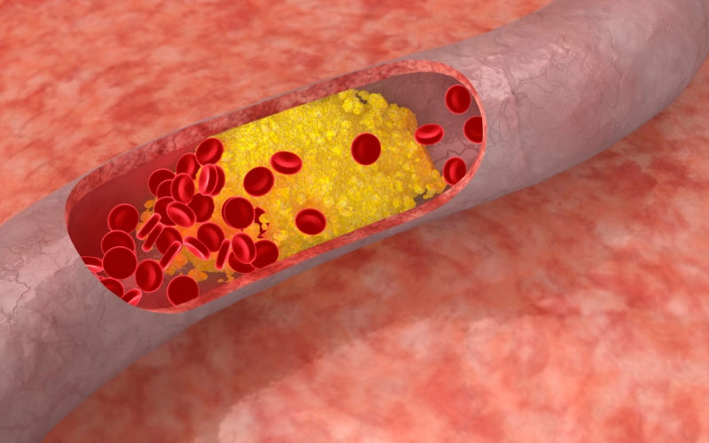 Giảm cholesterol trong máu